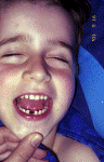 1st gap tooth